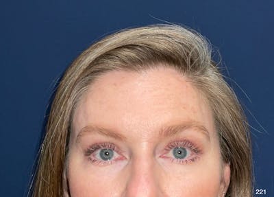Eyelid Surgery by Dr. Haydon Before & After Gallery - Patient 304363 - Image 2