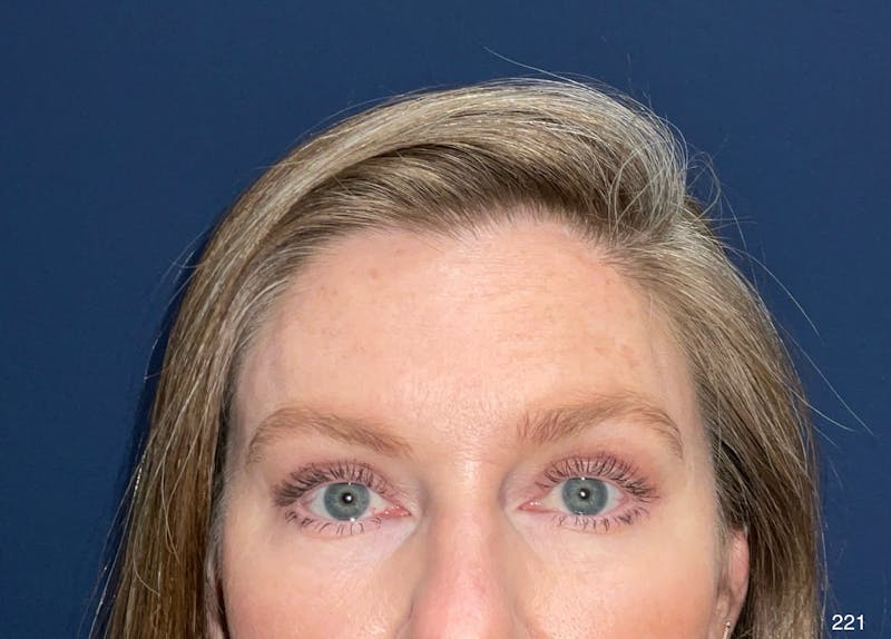 Eyelid Surgery by Dr. Haydon Before & After Gallery - Patient 304363 - Image 2
