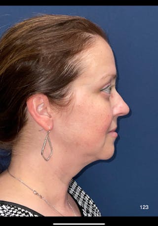 FaceTite/Morpheus8 by Dr. Haydon Before & After Gallery - Patient 152960 - Image 2