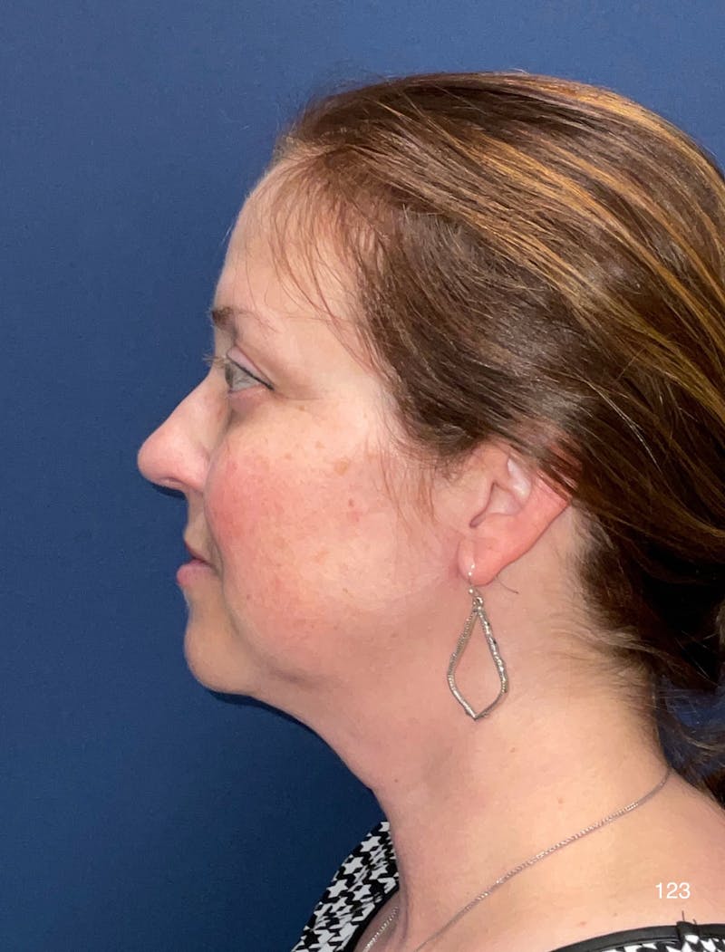 FaceTite/Morpheus8 by Dr. Haydon Before & After Gallery - Patient 152960 - Image 4