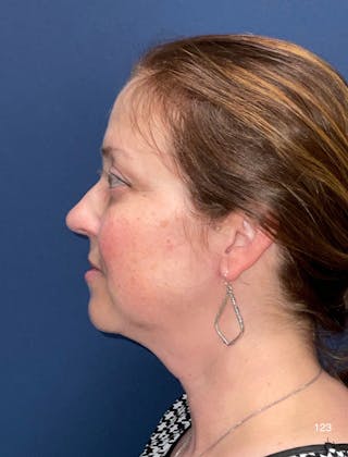 FaceTite/Morpheus8 by Dr. Haydon Before & After Gallery - Patient 152960 - Image 4