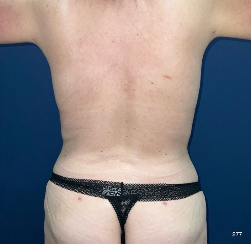 Tummy Tuck by Dr. Haydon Before & After Gallery - Patient 394819 - Image 4