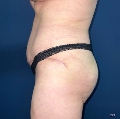 Tummy Tuck by Dr. Haydon Before & After Gallery - Patient 394819 - Image 2