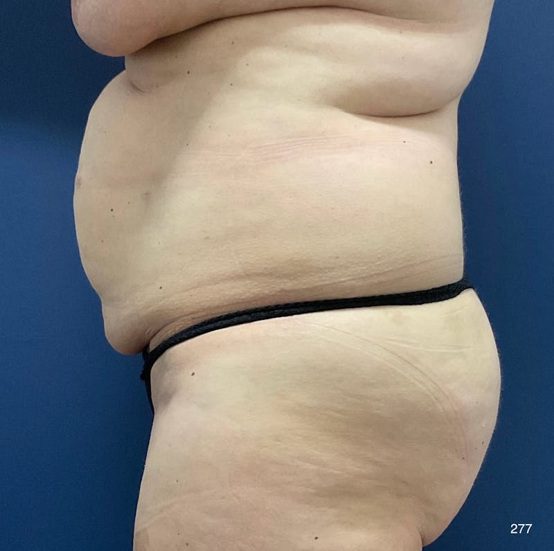 Tummy Tuck by Dr. Haydon Before & After Gallery - Patient 394819 - Image 1