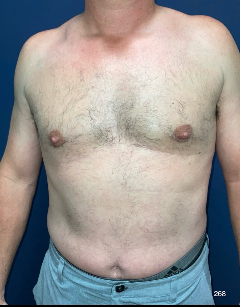 Gynecomastia by Dr. Haydon Before & After Gallery - Patient 412188 - Image 2