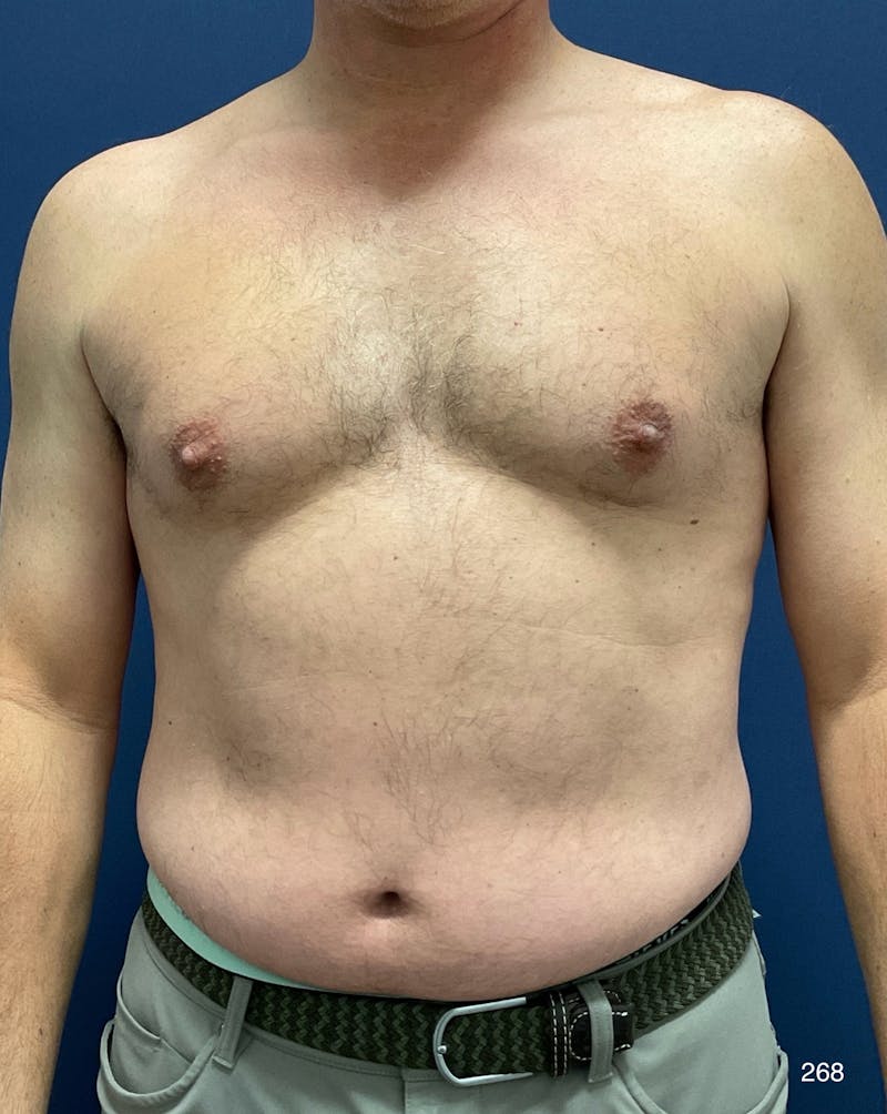 Gynecomastia by Dr. Haydon Before & After Gallery - Patient 412188 - Image 1