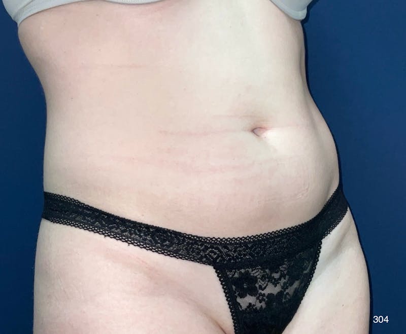 BodyTite/MorpheusBody by Dr. Haydon Before & After Gallery - Patient 165062 - Image 3