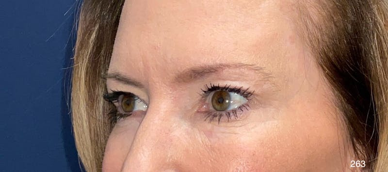 Eyelid Surgery by Dr. Haydon Before & After Gallery - Patient 912270 - Image 3