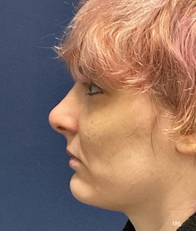 Rhinoplasty by Dr. Haydon Before & After Gallery - Patient 286964 - Image 2