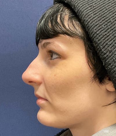 Rhinoplasty by Dr. Haydon Before & After Gallery - Patient 286964 - Image 1