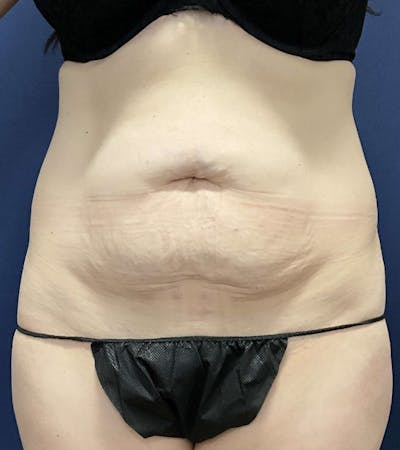 Tummy Tuck by Dr. Booth Before & After Gallery - Patient 162461 - Image 1