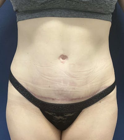 Tummy Tuck by Dr. Booth Before & After Gallery - Patient 162461 - Image 2