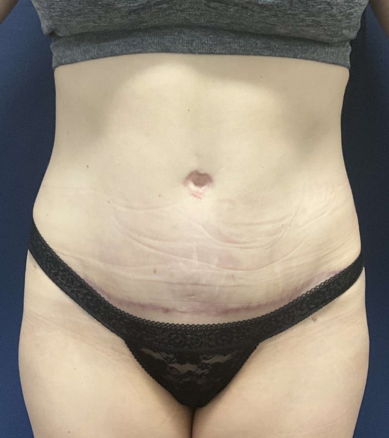 Tummy Tuck by Dr. Booth Before & After Gallery - Patient 162461 - Image 2