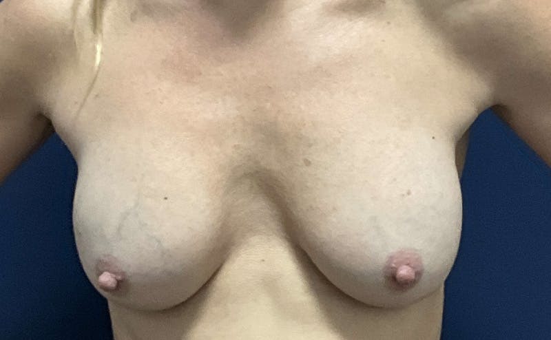 Breast Lift by Dr. Booth Before & After Gallery - Patient 136046 - Image 1