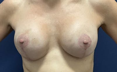 Implant Exchange by Dr. Booth Before & After Gallery - Patient 137593 - Image 2