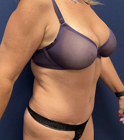 Liposuction by Dr. Booth Before & After Gallery - Patient 188872 - Image 2