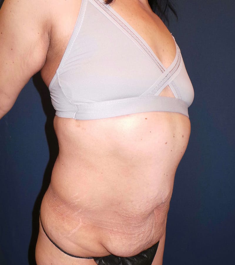 Lipo 360 by Dr. Booth Before & After Gallery - Patient 361138 - Image 1