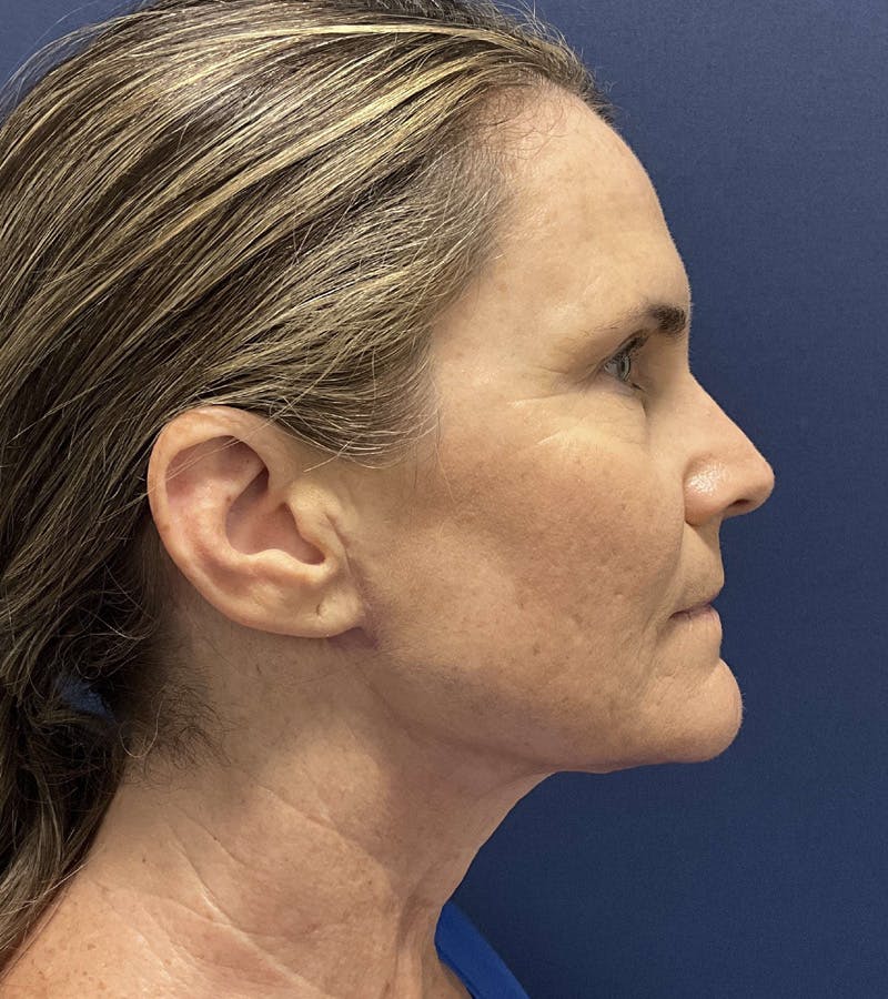 Submental Liposuction by Dr. Booth Before & After Gallery - Patient 415023 - Image 2