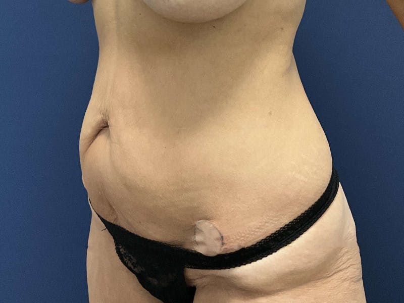 Tummy Tuck by Dr. Booth Before & After Gallery - Patient 115525 - Image 3