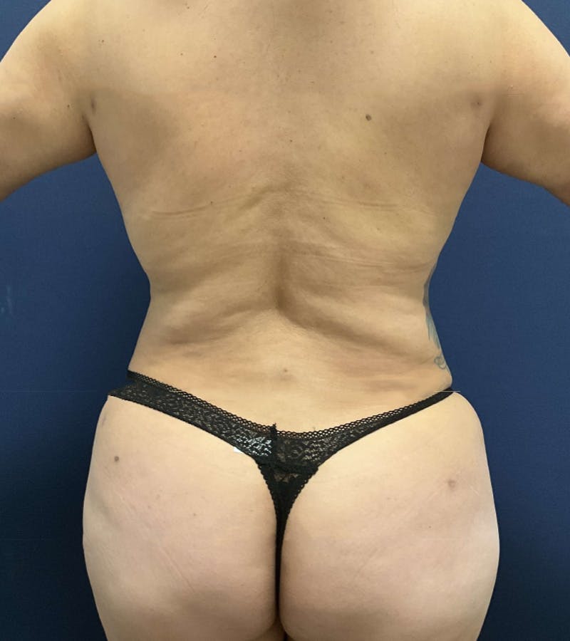 Liposuction by Dr. Booth Before & After Gallery - Patient 384237 - Image 2