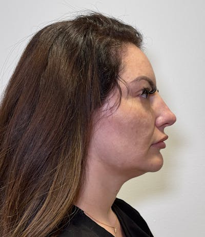 MyEllevate by Dr. Booth Before & After Gallery - Patient 192790 - Image 1