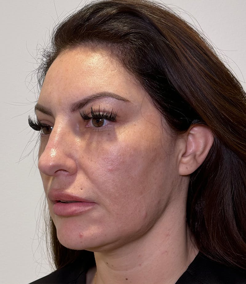 MyEllevate by Dr. Booth Before & After Gallery - Patient 192790 - Image 5