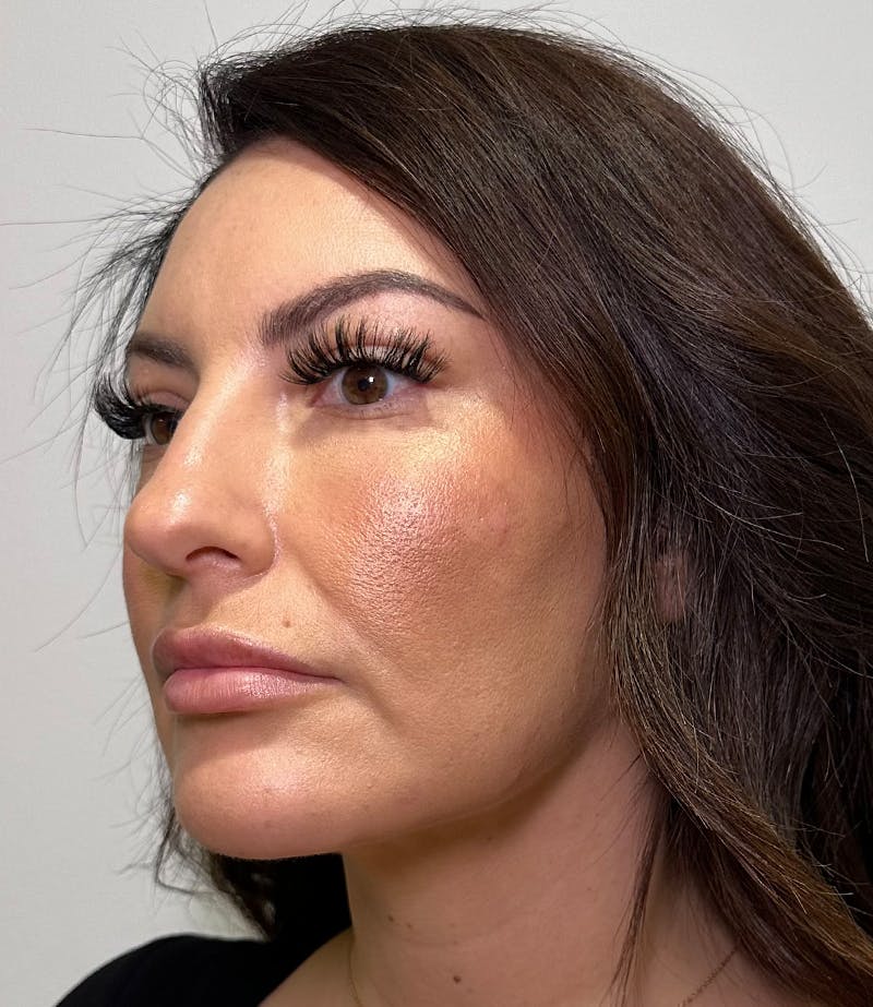 MyEllevate by Dr. Booth Before & After Gallery - Patient 192790 - Image 6