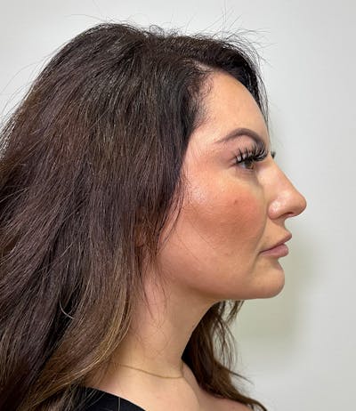 MyEllevate by Dr. Booth Before & After Gallery - Patient 192790 - Image 2