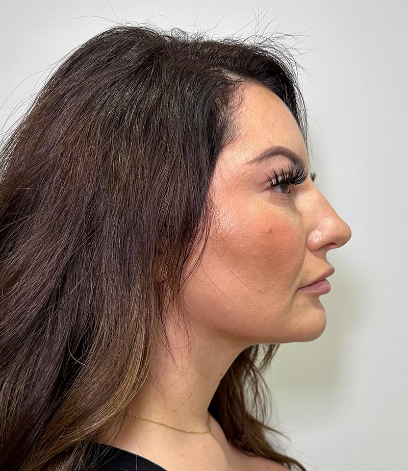MyEllevate by Dr. Booth Before & After Gallery - Patient 192790 - Image 2