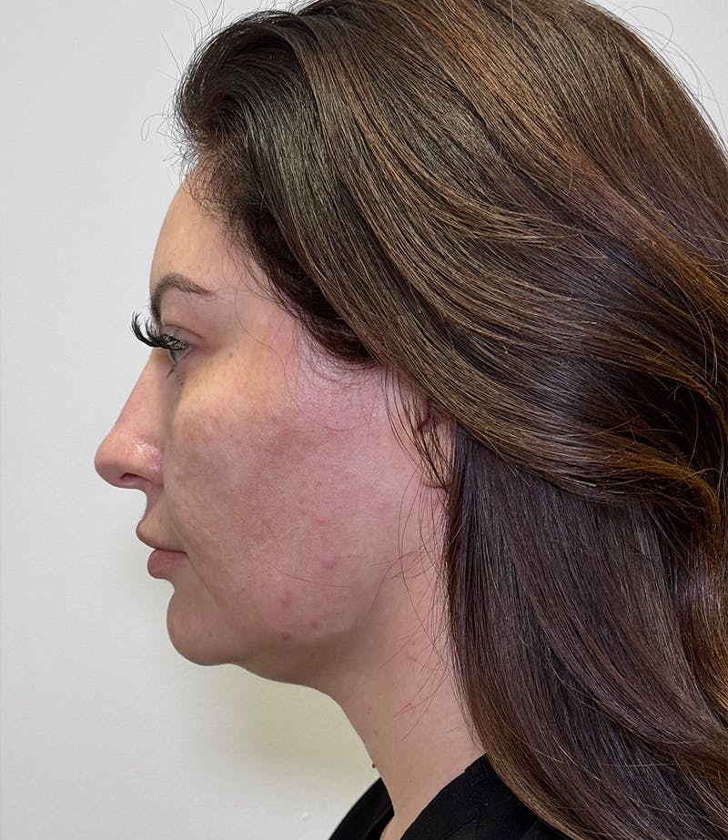 MyEllevate by Dr. Booth Before & After Gallery - Patient 192790 - Image 3