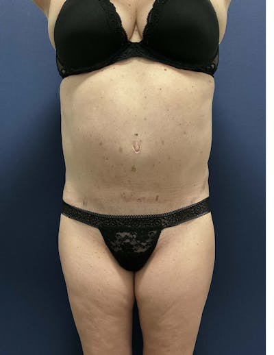Liposuction by Dr. Booth Before & After Gallery - Patient 332387 - Image 2