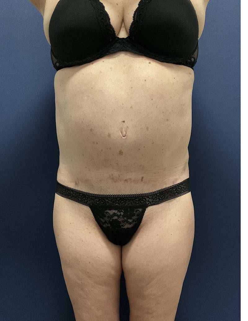 Liposuction by Dr. Booth Before & After Gallery - Patient 332387 - Image 2