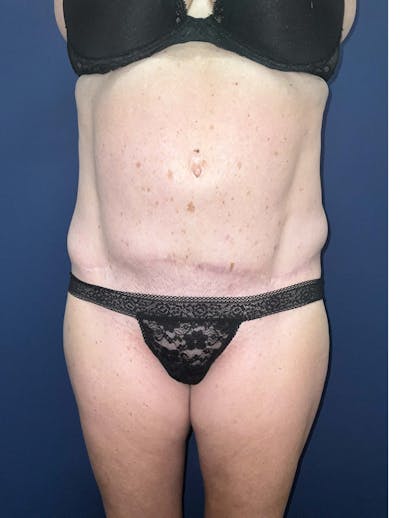 Liposuction by Dr. Booth Before & After Gallery - Patient 332387 - Image 1