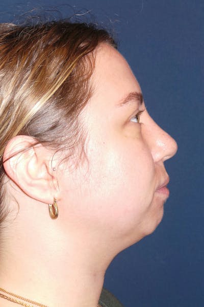 Submental Liposuction by Dr. Booth Before & After Gallery - Patient 281772 - Image 1
