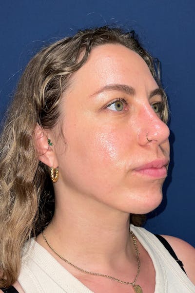 Chin Augmentation by Dr. Booth Before & After Gallery - Patient 353645 - Image 2