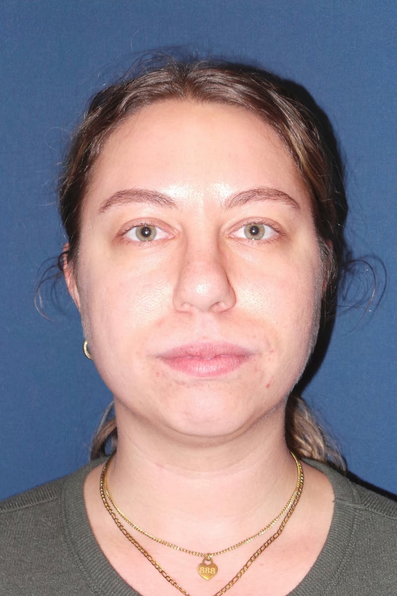 Submental Liposuction by Dr. Booth Before & After Gallery - Patient 281772 - Image 3