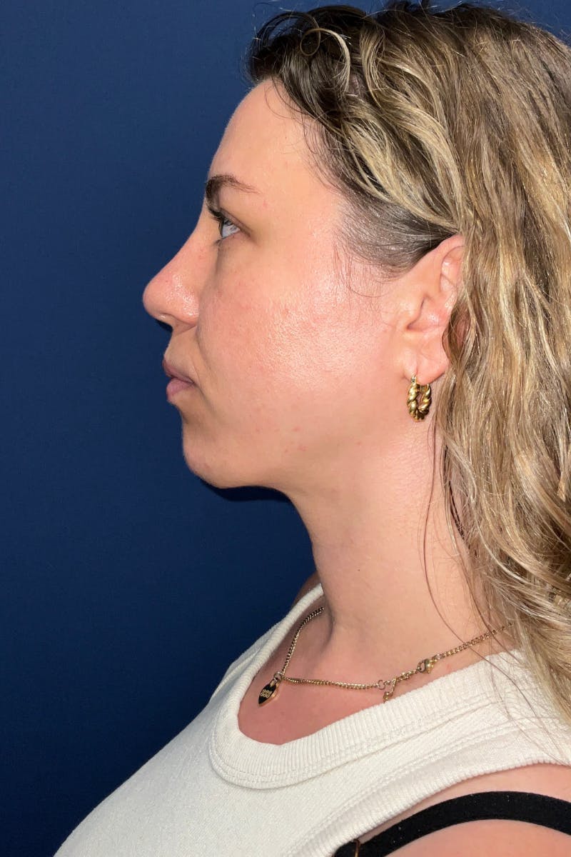 Submental Liposuction by Dr. Booth Before & After Gallery - Patient 281772 - Image 8