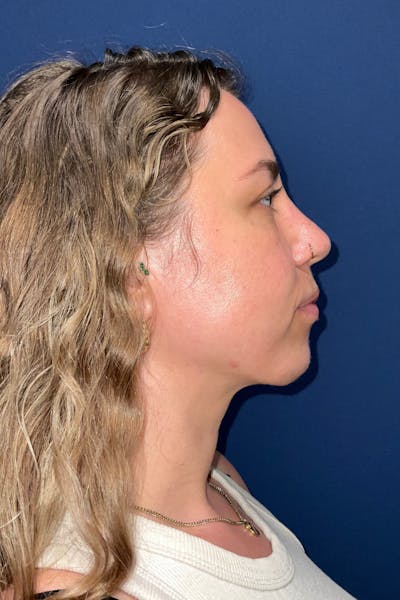 Submental Liposuction by Dr. Booth Before & After Gallery - Patient 281772 - Image 2