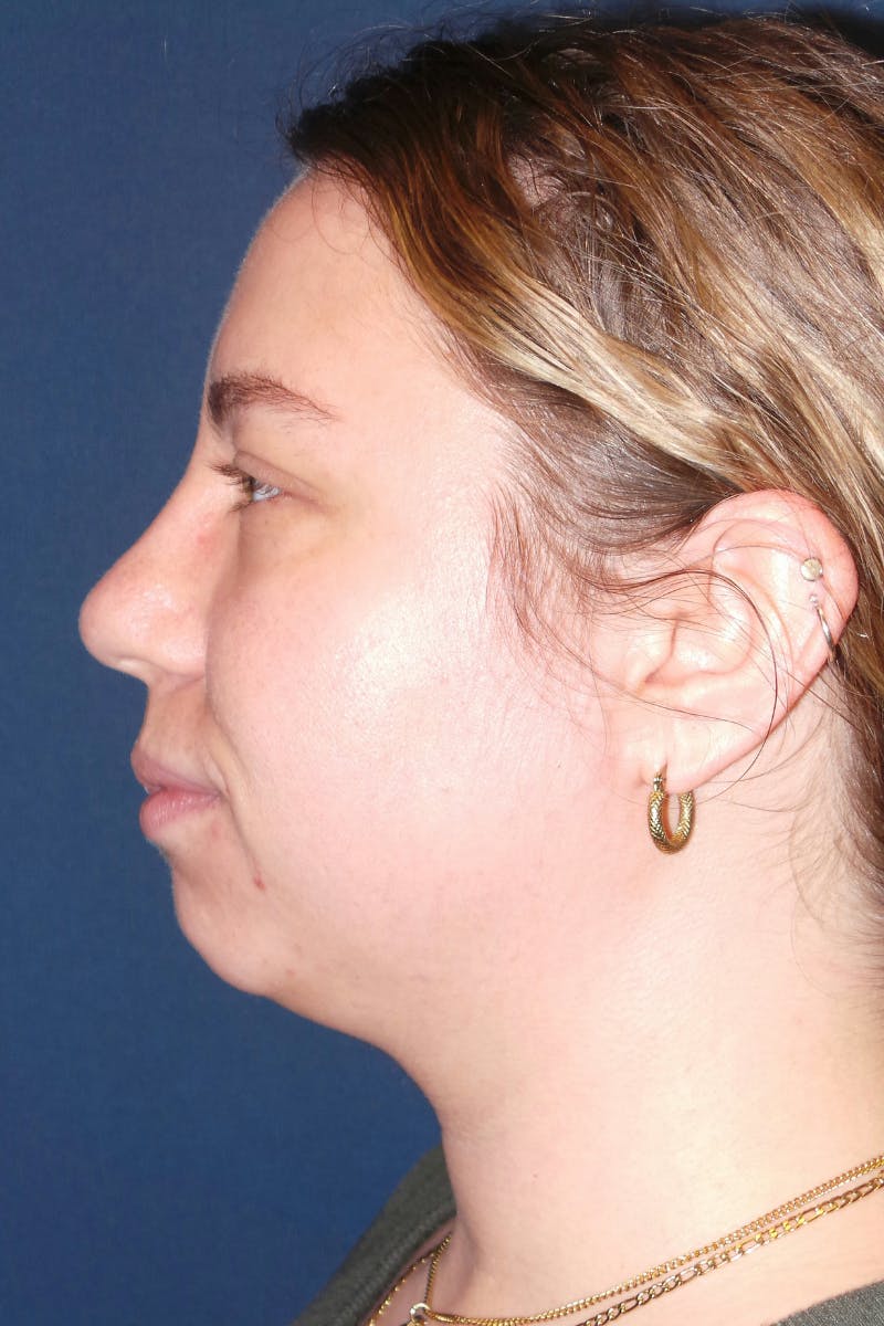 Submental Liposuction by Dr. Booth Before & After Gallery - Patient 281772 - Image 7