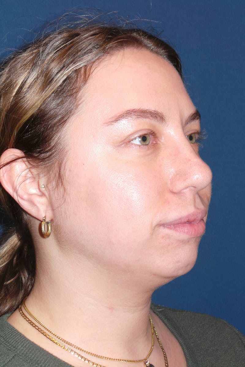 Submental Liposuction by Dr. Booth Before & After Gallery - Patient 281772 - Image 5