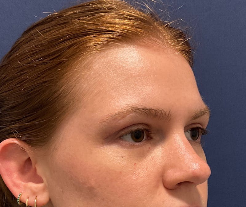 Upper Blepharoplasty by Dr. Booth Before & After Gallery - Patient 326776 - Image 4