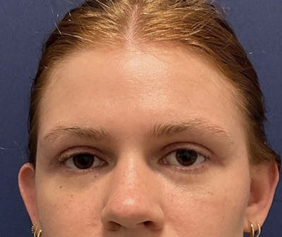 Upper Blepharoplasty by Dr. Booth Before & After Gallery - Patient 326776 - Image 2