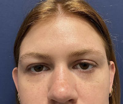 Upper Blepharoplasty by Dr. Booth Before & After Gallery - Patient 326776 - Image 1