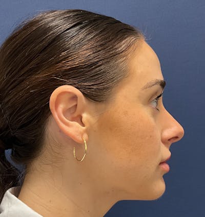 MyEllevate by Dr. Booth Before & After Gallery - Patient 162015 - Image 2