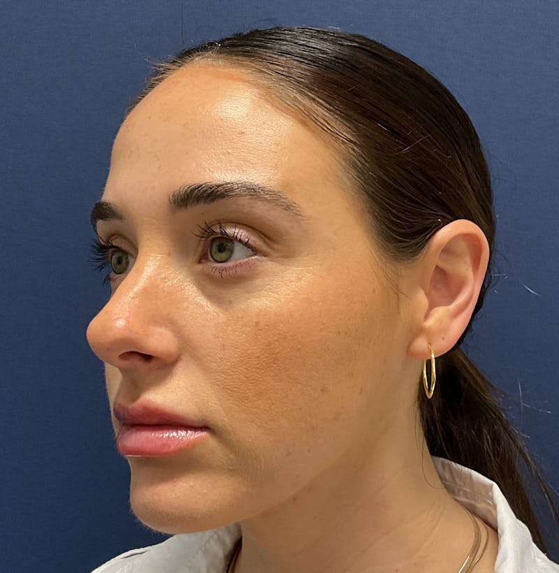 MyEllevate by Dr. Booth Before & After Gallery - Patient 162015 - Image 4
