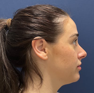 MyEllevate by Dr. Booth Before & After Gallery - Patient 162015 - Image 1