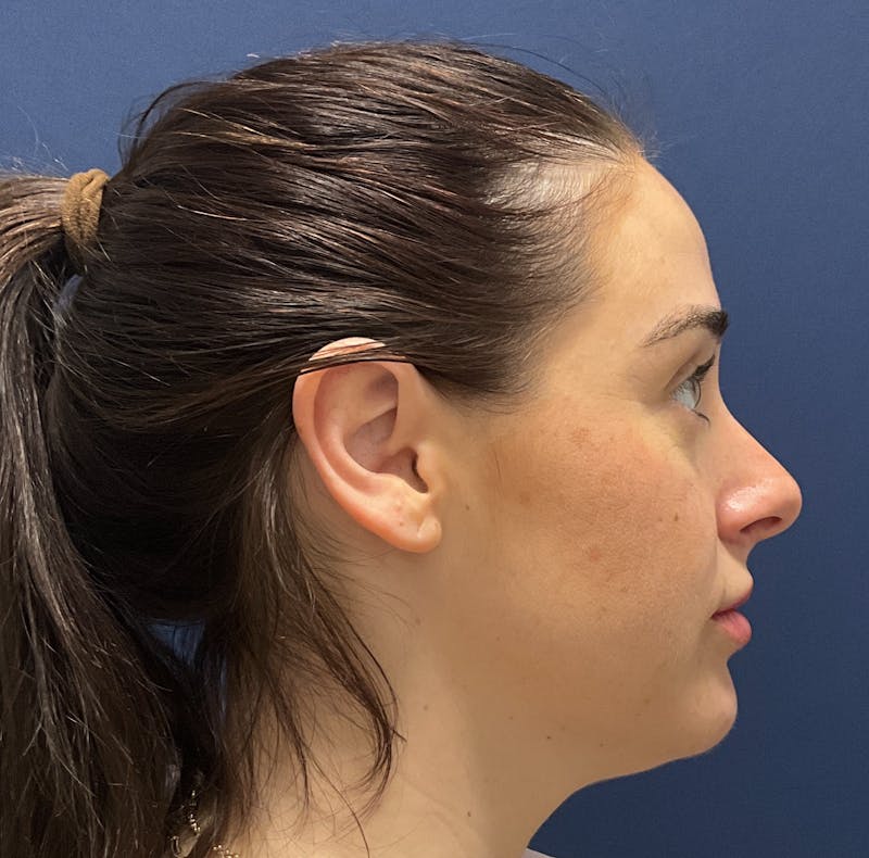 MyEllevate by Dr. Booth Before & After Gallery - Patient 162015 - Image 1