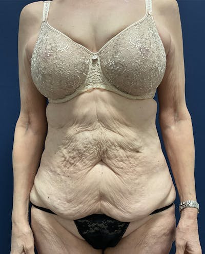 Tummy Tuck by Dr. Booth Before & After Gallery - Patient 323399 - Image 1