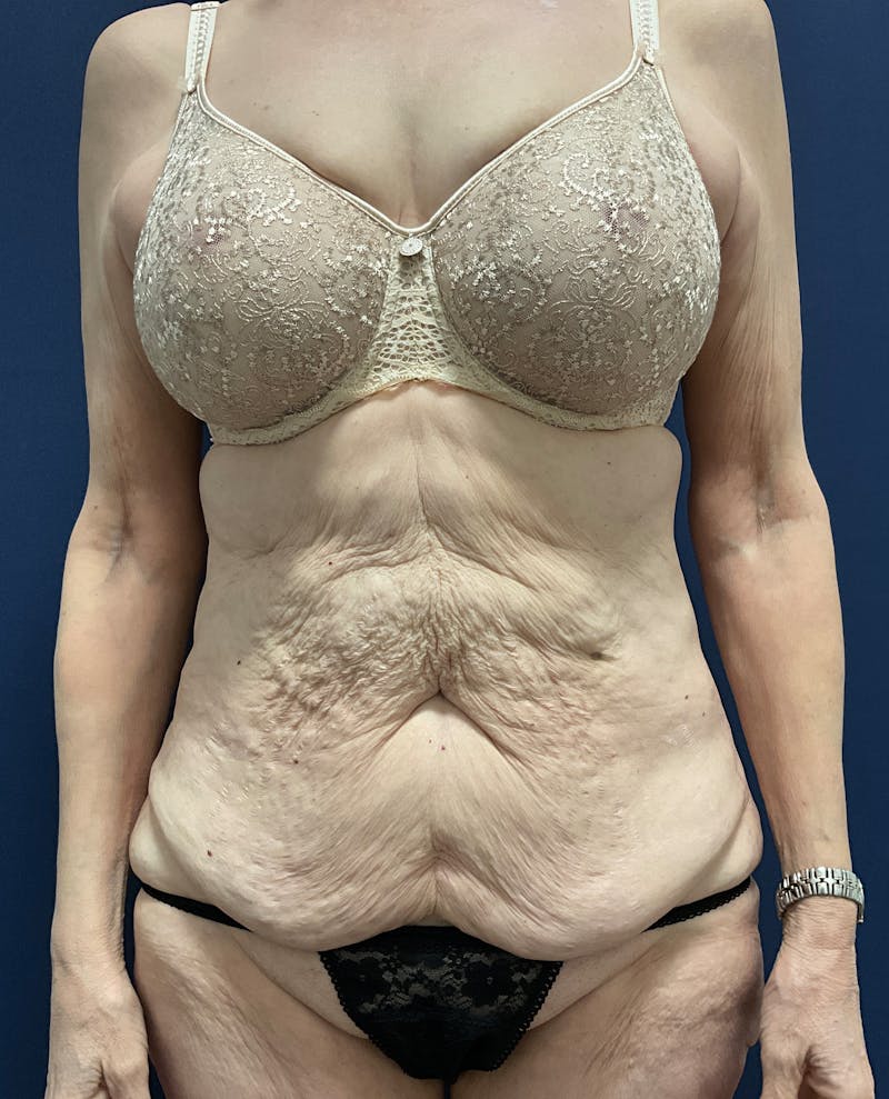 Tummy Tuck by Dr. Booth Before & After Gallery - Patient 323399 - Image 1