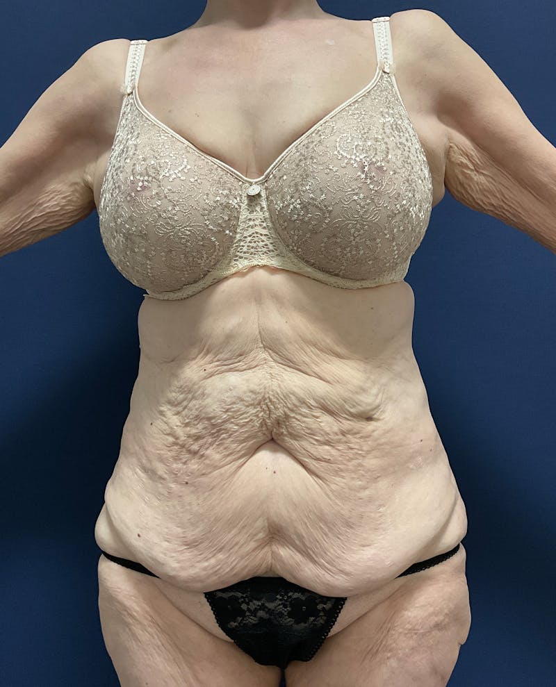 Tummy Tuck by Dr. Booth Before & After Gallery - Patient 323399 - Image 3